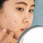 7 Cara Efektif Mengatasi Perawatan Kulit Berminyak dan Berjerawat yang Bisa Kamu Coba Hari Ini!