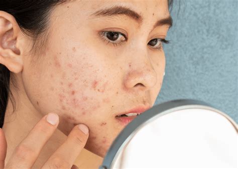 7 Cara Efektif Mengatasi Perawatan Kulit Berminyak dan Berjerawat yang Bisa Kamu Coba Hari Ini!
