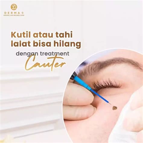 7 Fakta Mengejutkan Harga Treatment Cauter yang Bikin Dompet Bergetar!