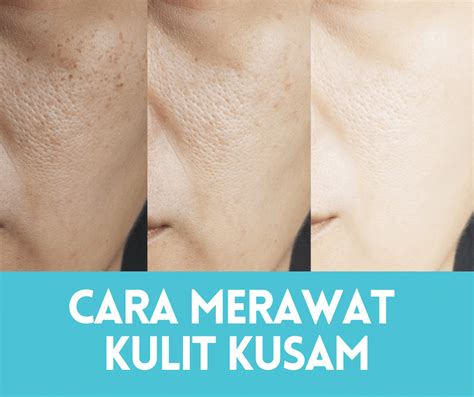 7 Langkah Ampuh Basmi Wajah Kusam dan Jerawat!