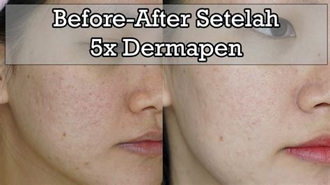7 Rahasia Kulit Glowing Setelah Dermapen: Wajib Coba5! 7 Rahasia Kulit Glowing Setelah Dermapen: Wajib Coba5!