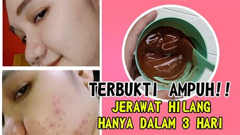 7 Rahasia Wajah Bebas Jerawat Alami: Terbukti Ampuh!