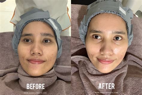 7 Treatment Wajah di ERHA di Bawah 500 Ribu! Budget Pas-pasan, Wajah Tetap Glowing!