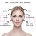 5 Cara Jitu Merawat Wajah Berjerawat and Sensitif: Bye-bye Iritasi!