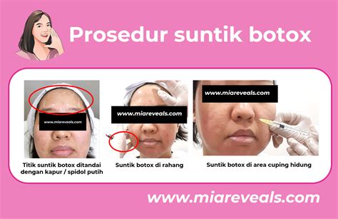5 Fakta Harga Botox Wajah di MS Glow: Mulai RpXXX? 5 Fakta Harga Botox Wajah di MS Glow: Mulai RpXXX?