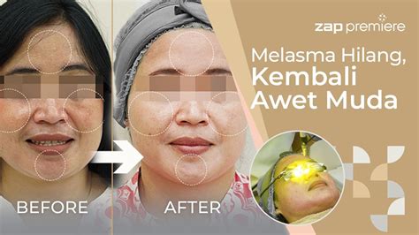 5 Paket Laser Wajah yang Bikin Wajah Glowing Alami (Mulai 99 Ribu!) 5 Paket Laser Wajah yang Bikin Wajah Glowing Alami (Mulai 99 Ribu!)