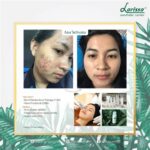 5 Paket Perawatan Larissa, Harga Mulai Rp 500.000!  💃