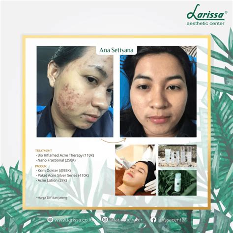 5 Paket Perawatan Larissa, Harga Mulai Rp 500.000!  💃