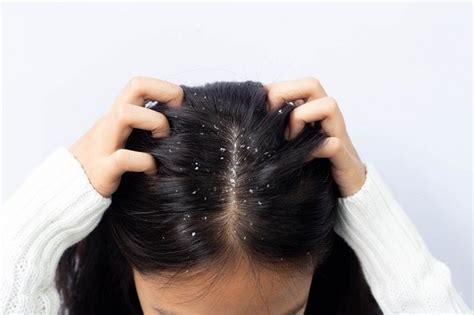 5 Treatment Kulit Kepala TERBAIK untuk Rambut Lebih Sehat and Tebal! 5 Treatment Kulit Kepala TERBAIK untuk Rambut Lebih Sehat and Tebal!