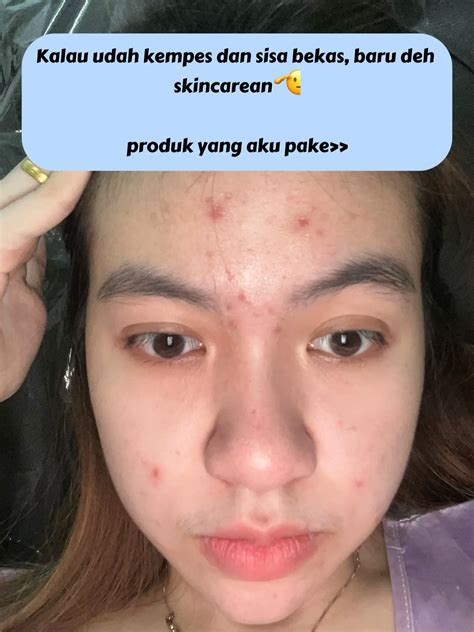 7 Cara Ajaib Collagen Hempas Jerawat dan Bekasnya! 7 Cara Ajaib Collagen Hempas Jerawat dan Bekasnya!