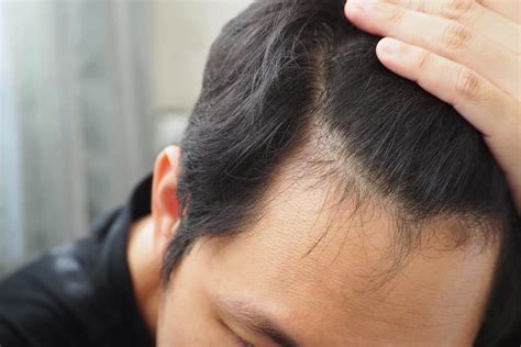 7 Cara Alami untuk Mengatasi Kulit Kepala Kering dan Mengelupas yang Wajib Kamu Coba! 7 Cara Alami untuk Mengatasi Kulit Kepala Kering dan Mengelupas yang Wajib Kamu Coba!