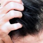 7 Cara Alami untuk Mengatasi Kulit Kepala Kering dan Mengelupas yang Wajib Kamu Coba!