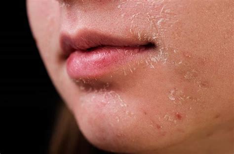 7 Cara Alami untuk Mengatasi Kulit Kepala Kering dan Mengelupas yang Wajib Kamu Coba! 7 Cara Alami untuk Mengatasi Kulit Kepala Kering dan Mengelupas yang Wajib Kamu Coba!