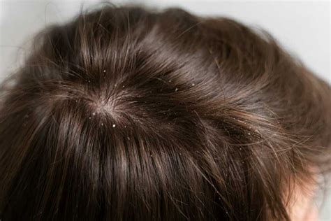 7 Cara Alami untuk Mengatasi Kulit Kepala Kering dan Mengelupas yang Wajib Kamu Coba! 7 Cara Alami untuk Mengatasi Kulit Kepala Kering dan Mengelupas yang Wajib Kamu Coba!