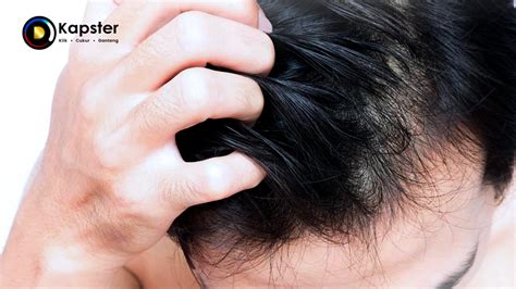 7 Cara Alami untuk Mengatasi Kulit Kepala Kering dan Mengelupas yang Wajib Kamu Coba!