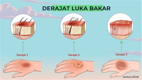 7 Cara Mengatasi Luka Bakar Menggelembung yang Perlu Diketahui untuk Mencegah Infeksi 7 Cara Mengatasi Luka Bakar Menggelembung yang Perlu Diketahui untuk Mencegah Infeksi