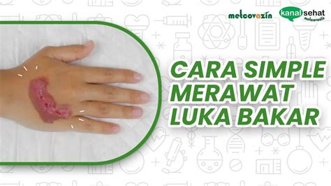7 Cara Mengatasi Luka Bakar Menggelembung yang Perlu Diketahui untuk Mencegah Infeksi 7 Cara Mengatasi Luka Bakar Menggelembung yang Perlu Diketahui untuk Mencegah Infeksi