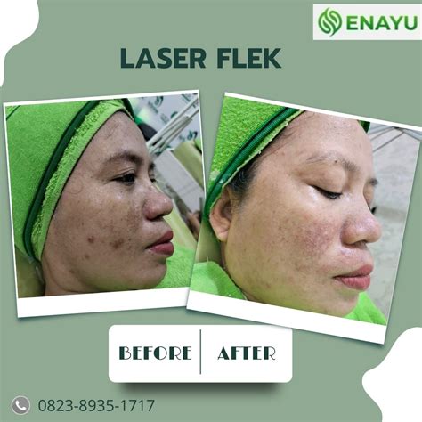 7 Harga Laser Diode Wajah Terbaik: Glowing Impian Mulai dari 99 Ribu! 7 Harga Laser Diode Wajah Terbaik: Glowing Impian Mulai dari 99 Ribu!