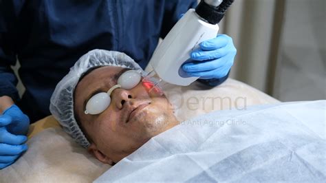7 Keajaiban Laser CO2: Kulit Mulus Tanpa Cela! 7 Keajaiban Laser CO2: Kulit Mulus Tanpa Cela!