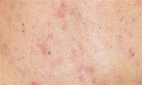 7 Langkah Skincare Wajib Setelah Laser: Kulit Mulus Bebas Iritasi! 7 Langkah Skincare Wajib Setelah Laser: Kulit Mulus Bebas Iritasi!