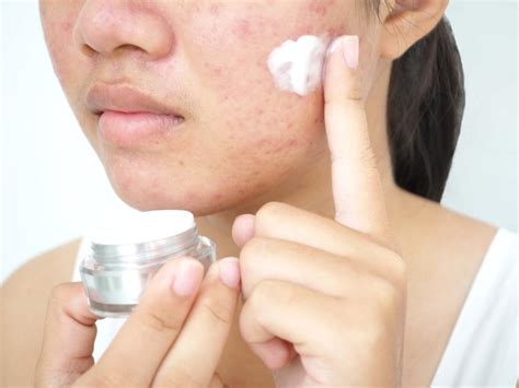 7 Rahasia Ampuh Perawatan Kulit Sensitif dan Berjerawat: Bye Bye Iritasi, Welcome Glowing! 7 Rahasia Ampuh Perawatan Kulit Sensitif dan Berjerawat: Bye Bye Iritasi, Welcome Glowing!