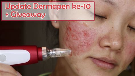 7 Rahasia Dermapen untuk Kulit Glowing Bebas Masalah 7 Rahasia Dermapen untuk Kulit Glowing Bebas Masalah