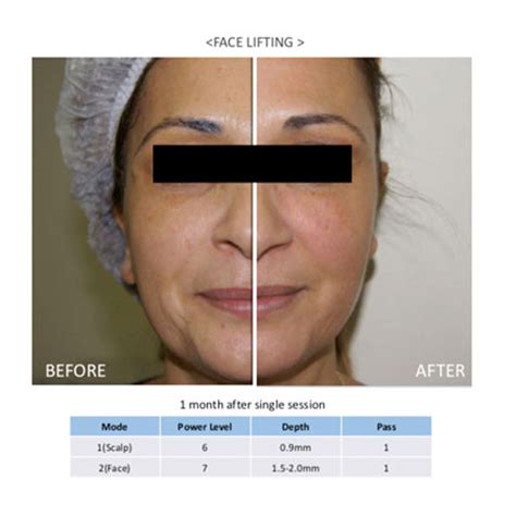 7 Treatment Bening's Clinic yang Bikin Wajah Glowing Instan, Nomor 5 Bikin Kaget! 7 Treatment Bening's Clinic yang Bikin Wajah Glowing Instan, Nomor 5 Bikin Kaget!