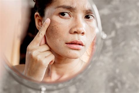 5 Skincare Alami Ampuh Lindungi Kulit Setelah Laser 5 Skincare Alami Ampuh Lindungi Kulit Setelah Laser