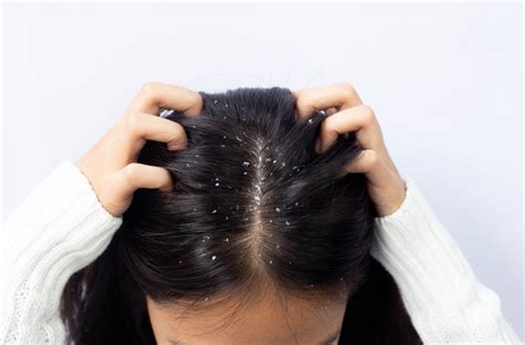 7 Treatment Kulit Kepala Alami yang Bisa Kamu Coba di Rumah untuk Atasi Ketombe dan Rambut Rontok! 7 Treatment Kulit Kepala Alami yang Bisa Kamu Coba di Rumah untuk Atasi Ketombe dan Rambut Rontok!